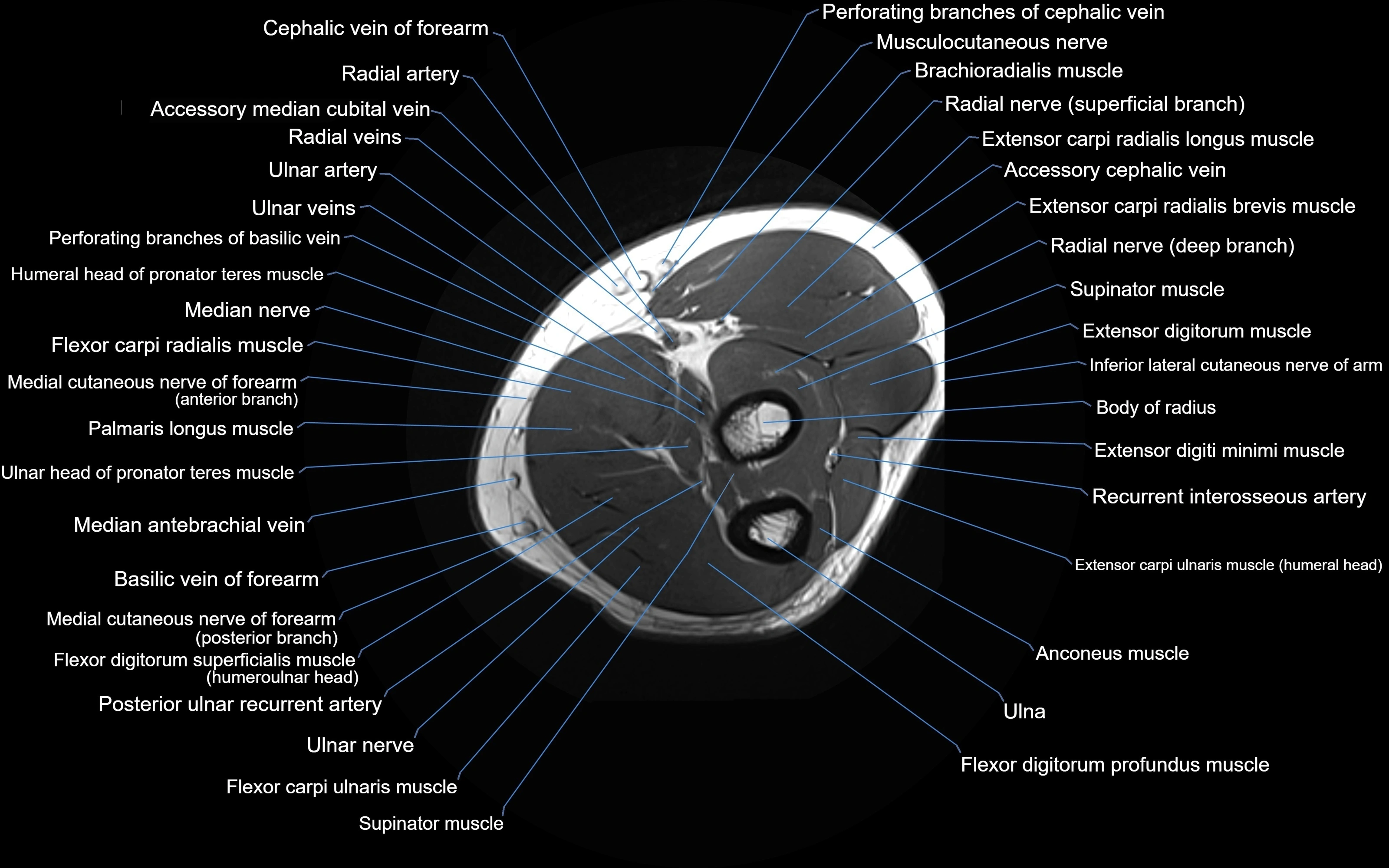 MRI elbow axial cross sectional anatomy 3T  radiology  image-img-00001-00026.webp
